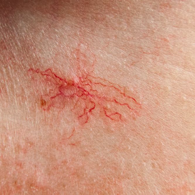 Thread Vein Treatment